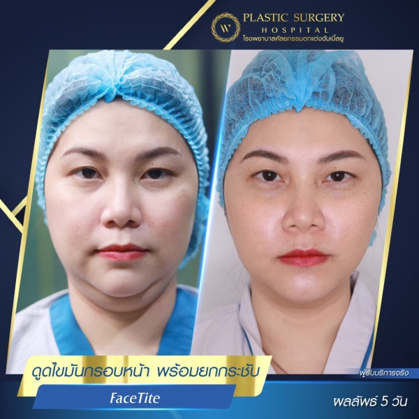 ดูดไขมันเหนียงใต้คาง (FaceTite)