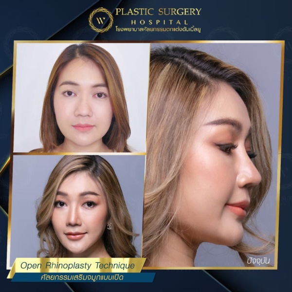 เสริมจมูก