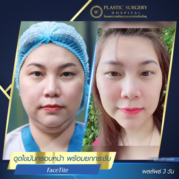 ดูดไขมันเหนียงใต้คาง (FaceTite)