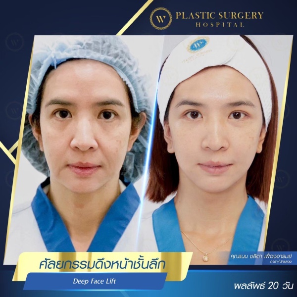 ดึงหน้า