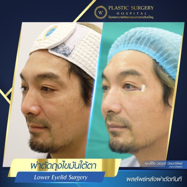 ตัดถุงไขมันใต้ตา