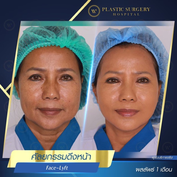 ดึงหน้า