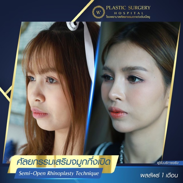 เสริมจมูก