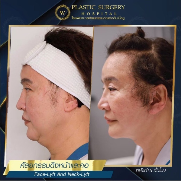 ดึงหน้า