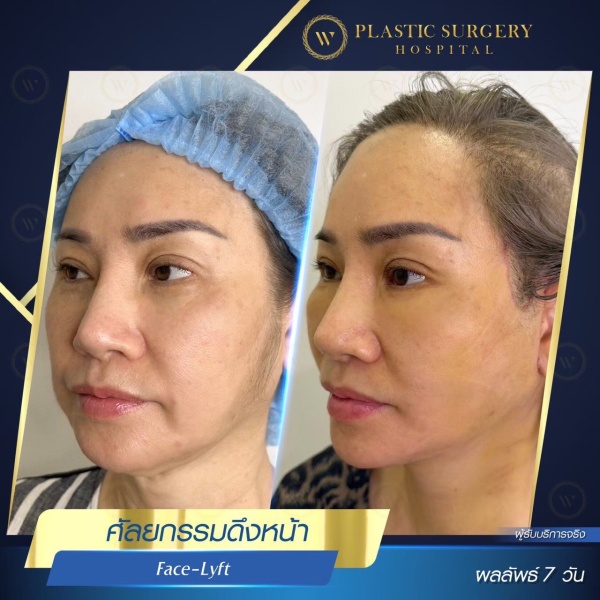 ดึงหน้า