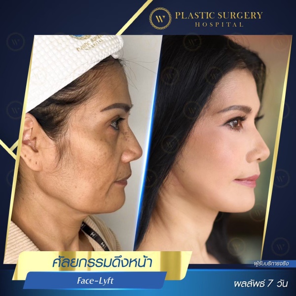 ดึงหน้า