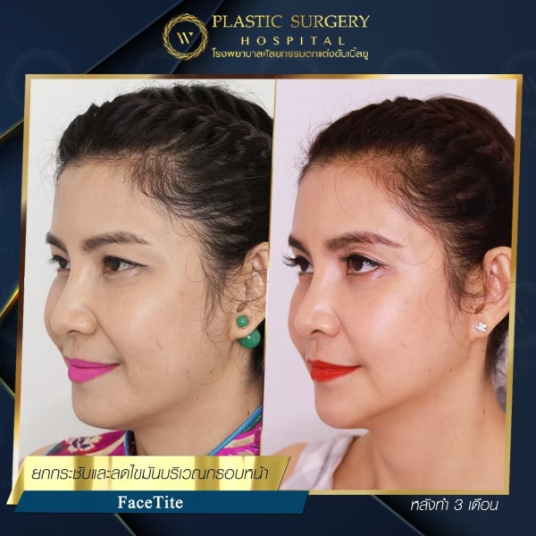 ดูดไขมันเหนียงใต้คาง (FaceTite)