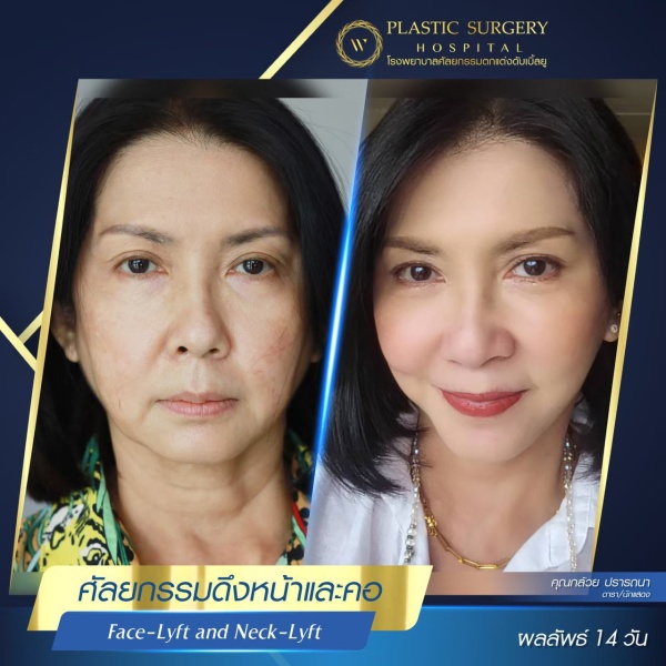 ดึงหน้า