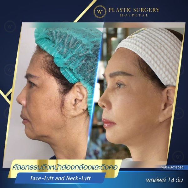 ดึงหน้า