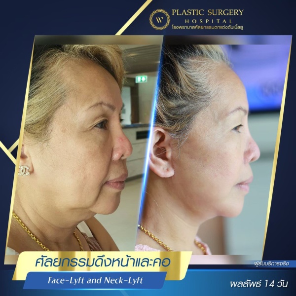 ดึงหน้า