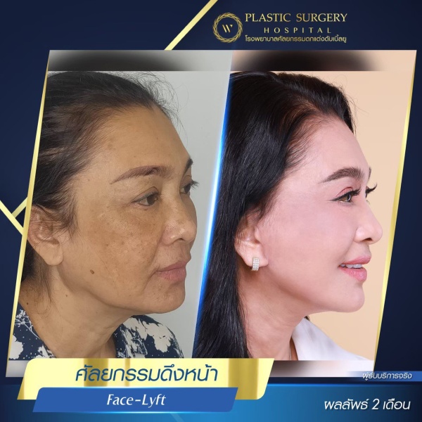 ดึงหน้า