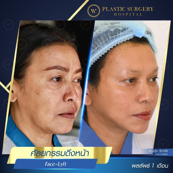 ดึงหน้า