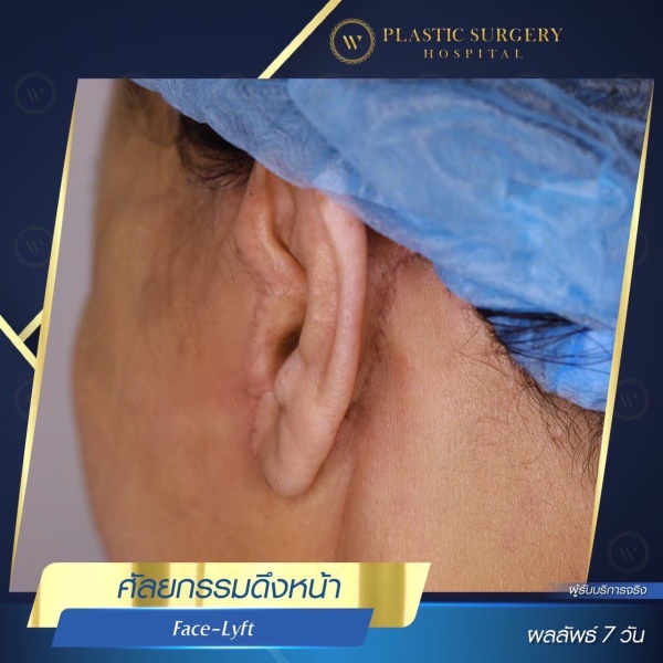 ดึงหน้า