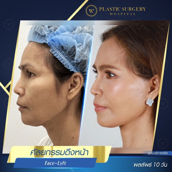 ดึงหน้า