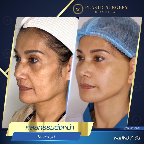 ดึงหน้า