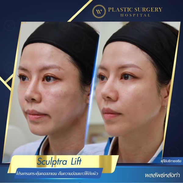 Sculptra Lift