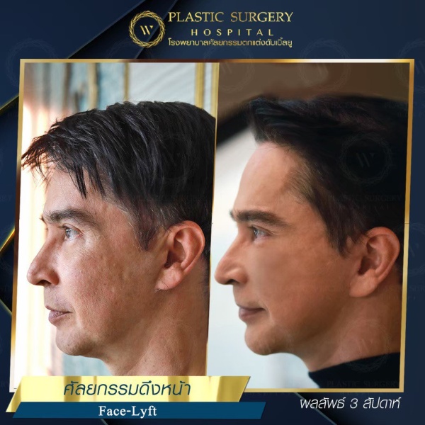 ดึงหน้า