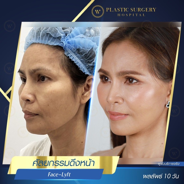 ดึงหน้า