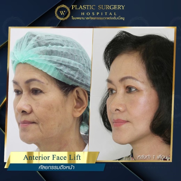 ดึงหน้า