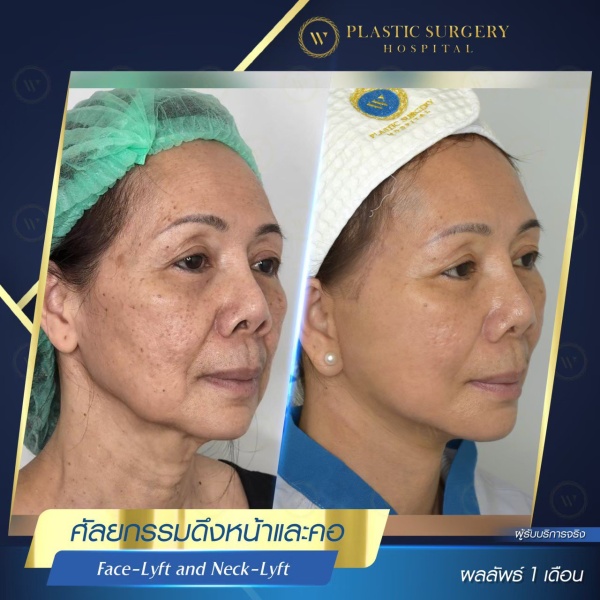 ดึงหน้า