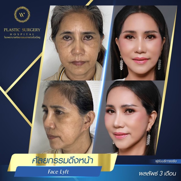 ดึงหน้า