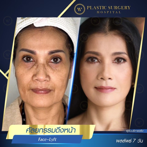 ดึงหน้า