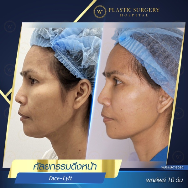 ดึงหน้า