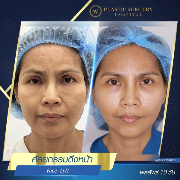 ดึงหน้า