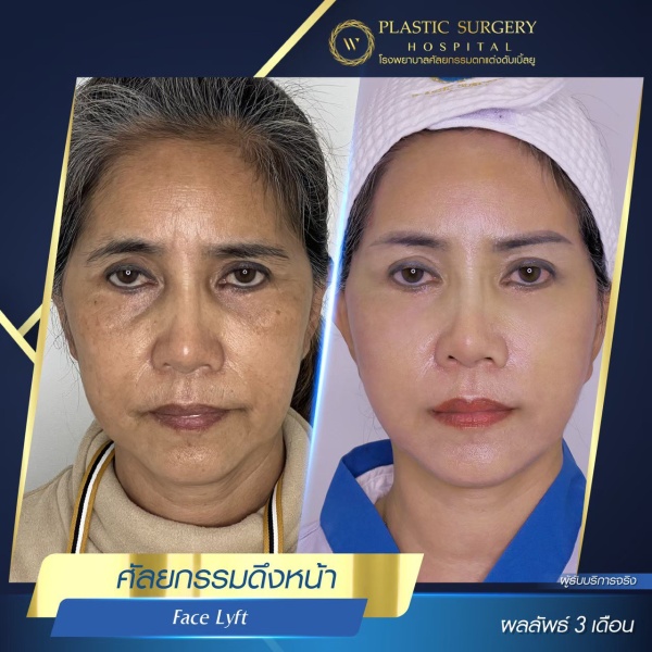 ดึงหน้า