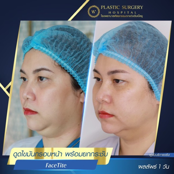 ดูดไขมันเหนียงใต้คาง (FaceTite)