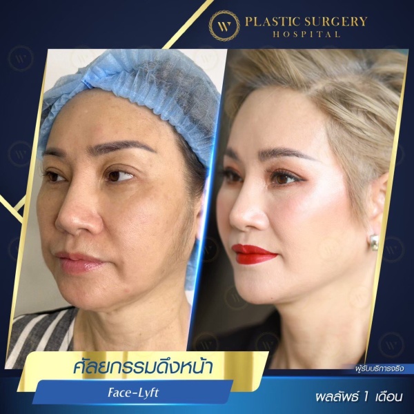 ดึงหน้า