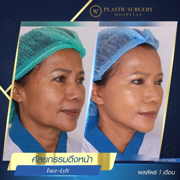 ดึงหน้า