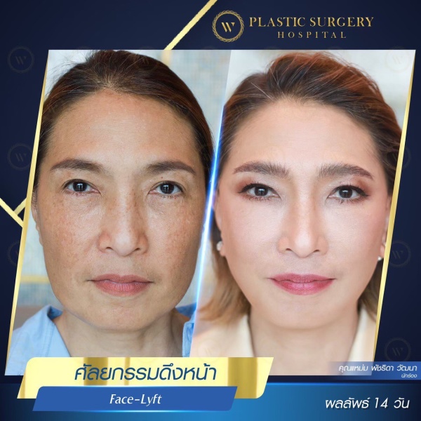 ดึงหน้า