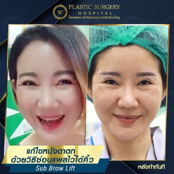 หนังตา/หางตาบนตก