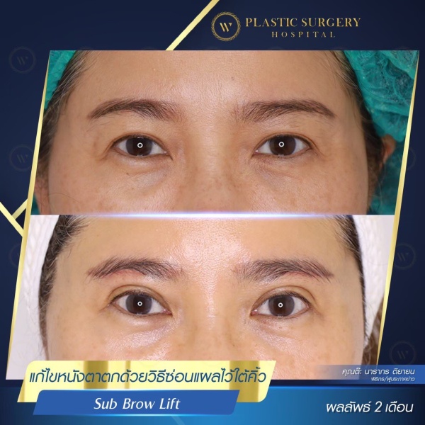 หนังตา/หางตาบนตก