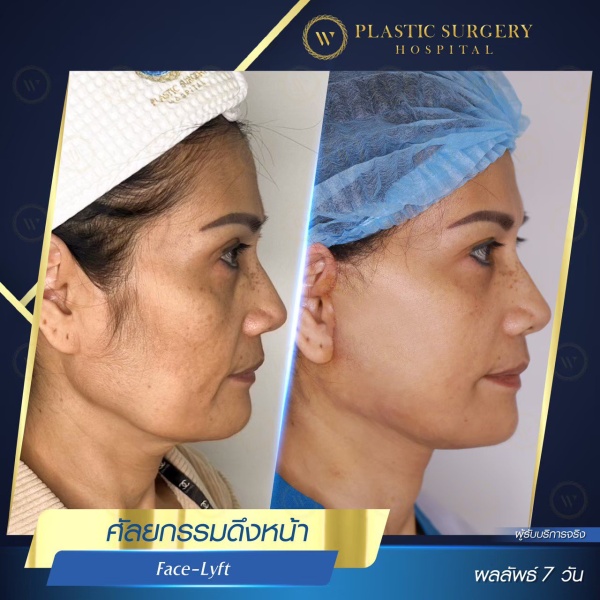 ดึงหน้า