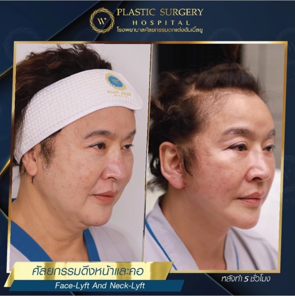 ดึงหน้า