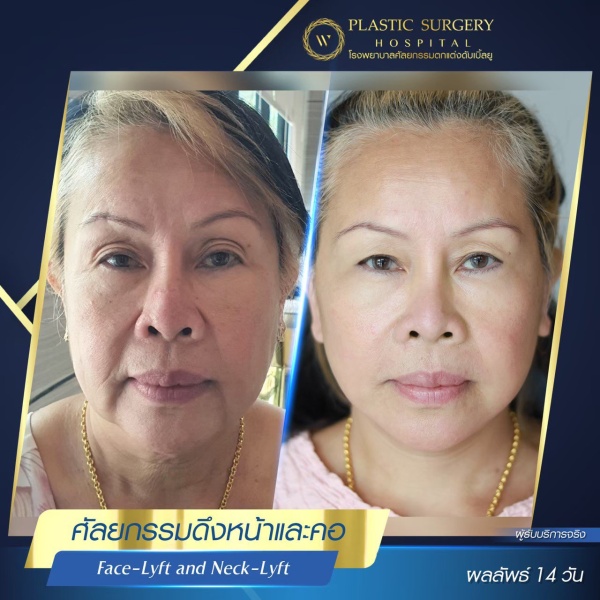 ดึงหน้า