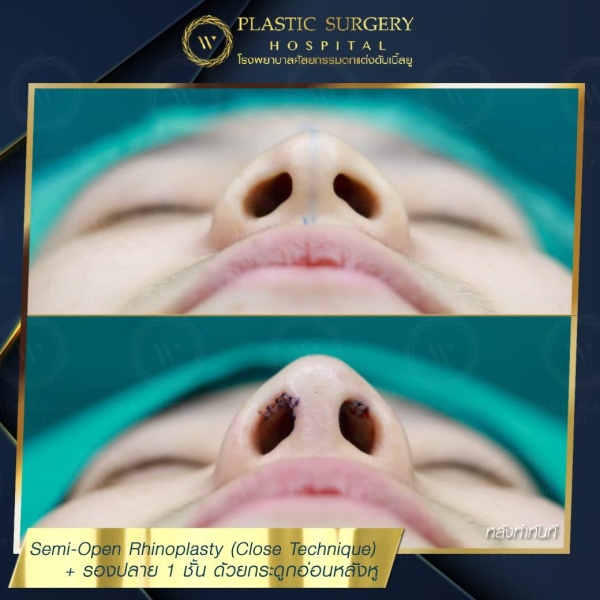 เสริมจมูก