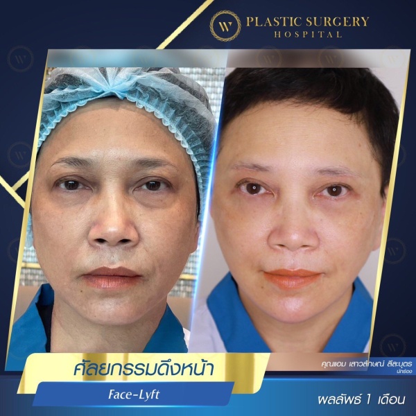 ดึงหน้า