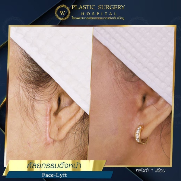 ดึงหน้า