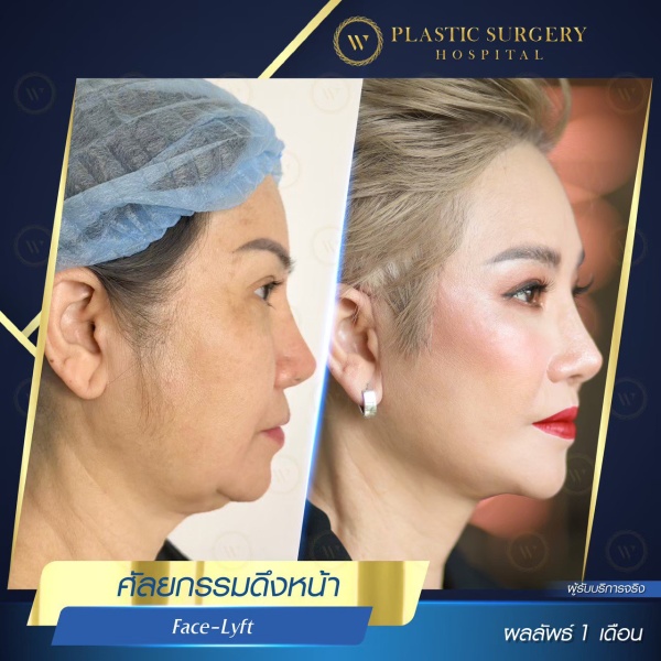 ดึงหน้า