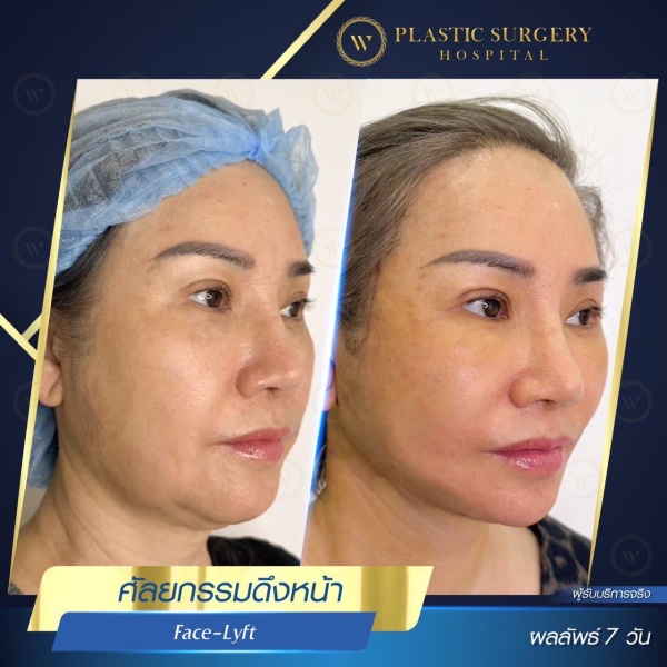 ดึงหน้า