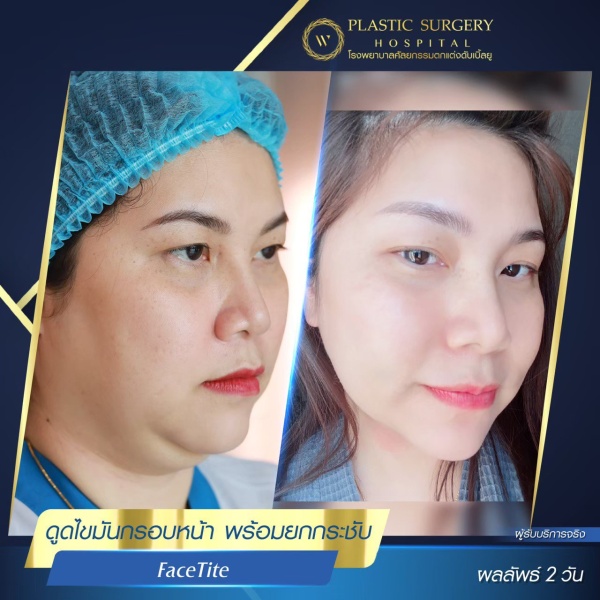 ดูดไขมันเหนียงใต้คาง (FaceTite)