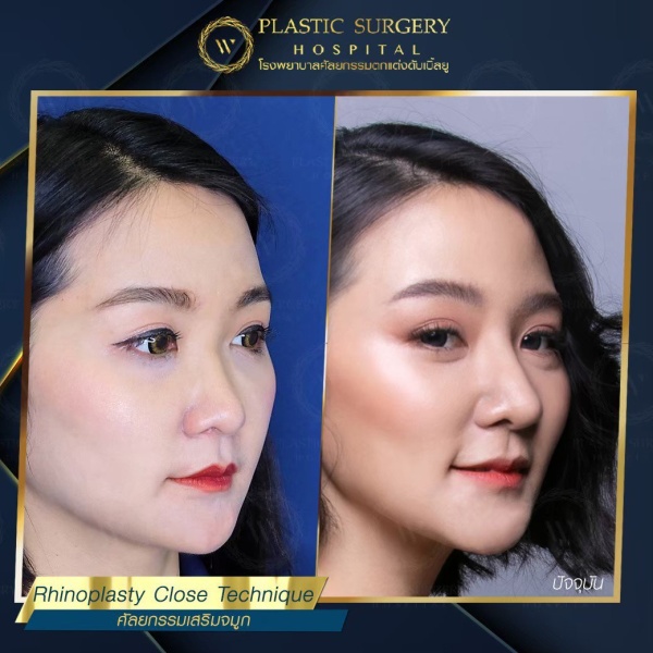 เสริมจมูก