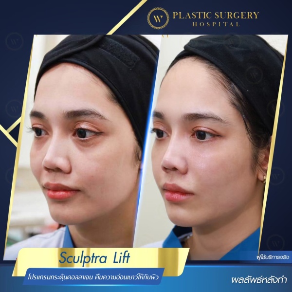 Sculptra Lift