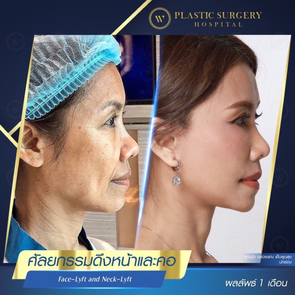 ดึงหน้า