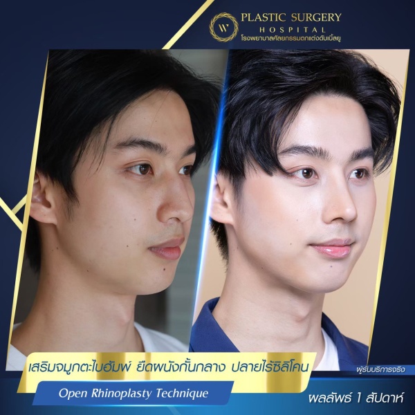 เสริมจมูก