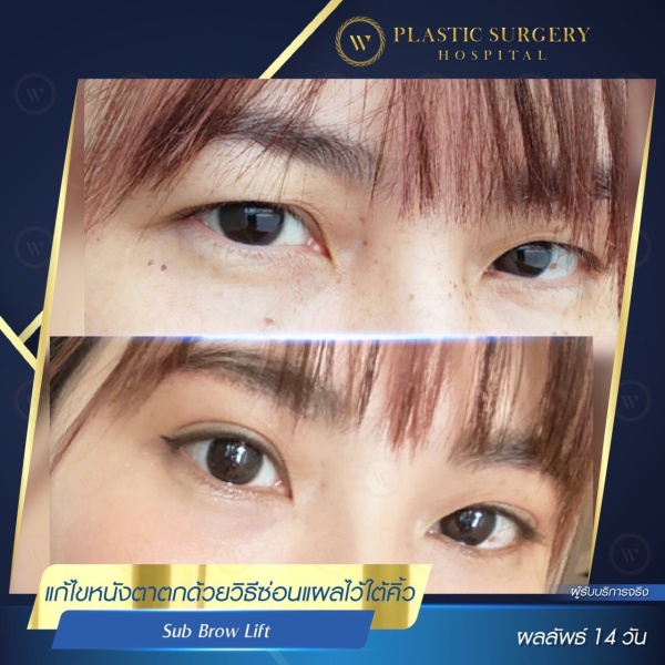 หนังตา/หางตาบนตก