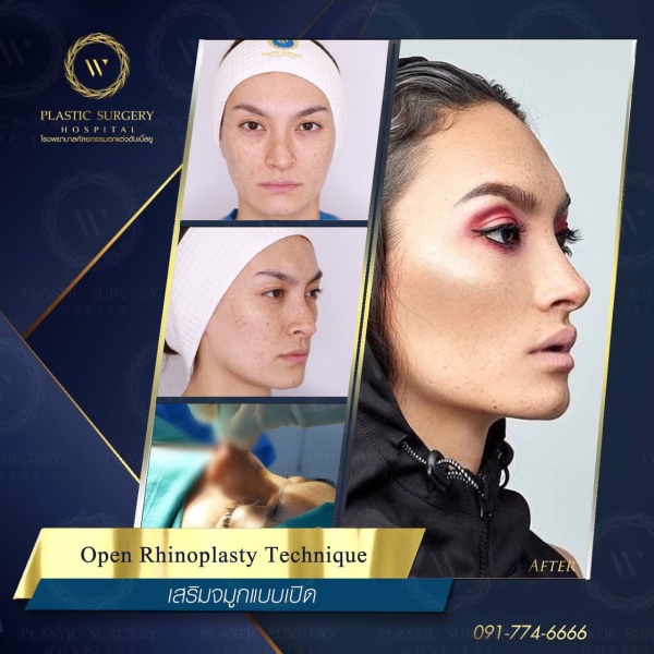 เสริมจมูก